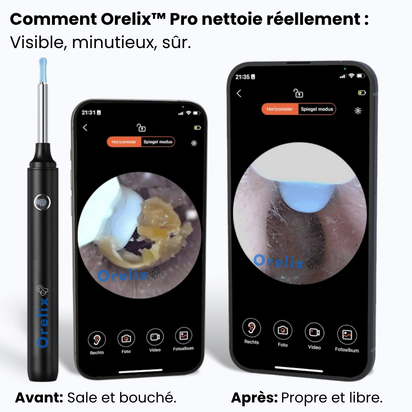 Orelix™ Pro